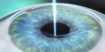 femto-lasik-1